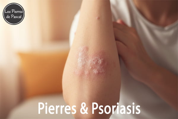 Psoriasis : Les Meilleures Pierres pour Accompagner, Apaiser et Soutenir | Par Pascal Artisan